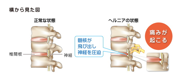 20~40代の男性に多い椎間板ヘルニア