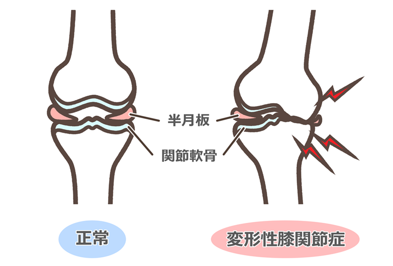 50代以上の女性に多い変形性膝関節症